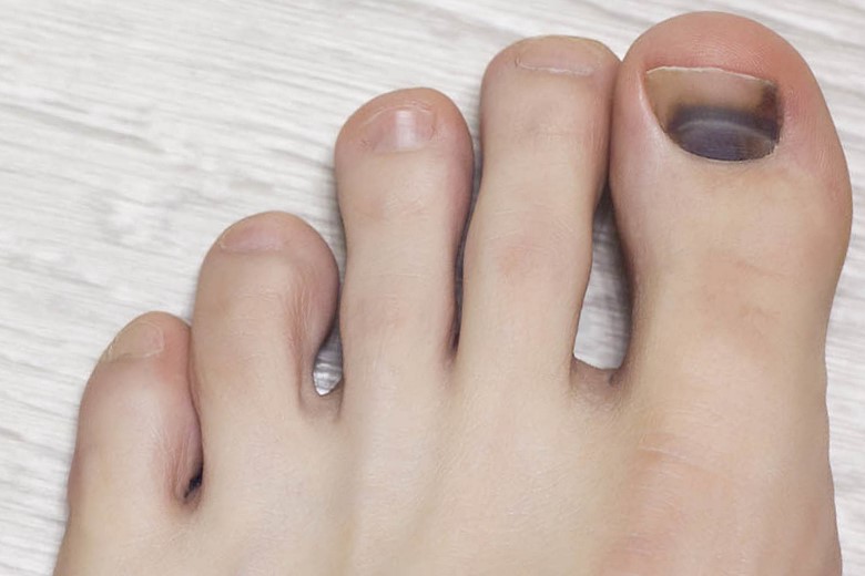 Причины почернения ногтей на ногах